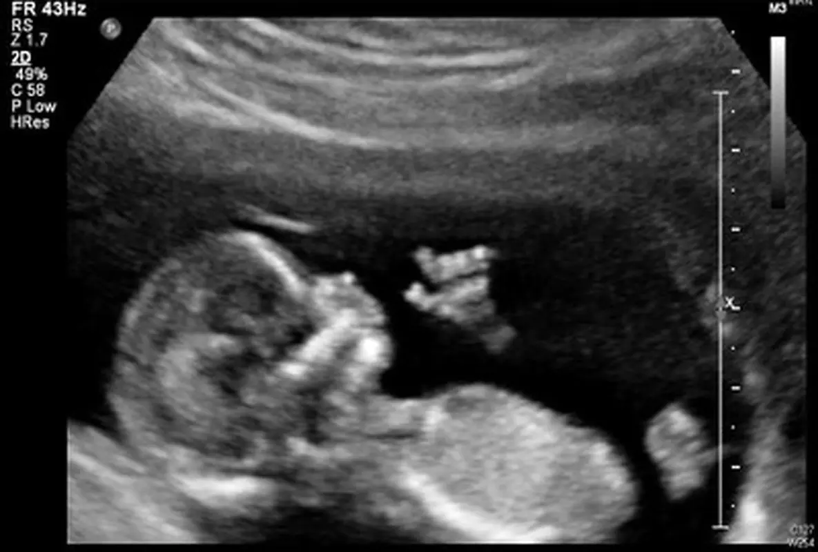 تست غربالگری سه ماهه اول، ضرورت دارد؟