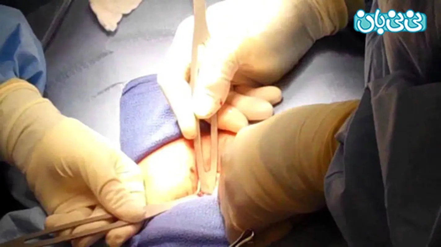 بستن لوله رحم در زنان