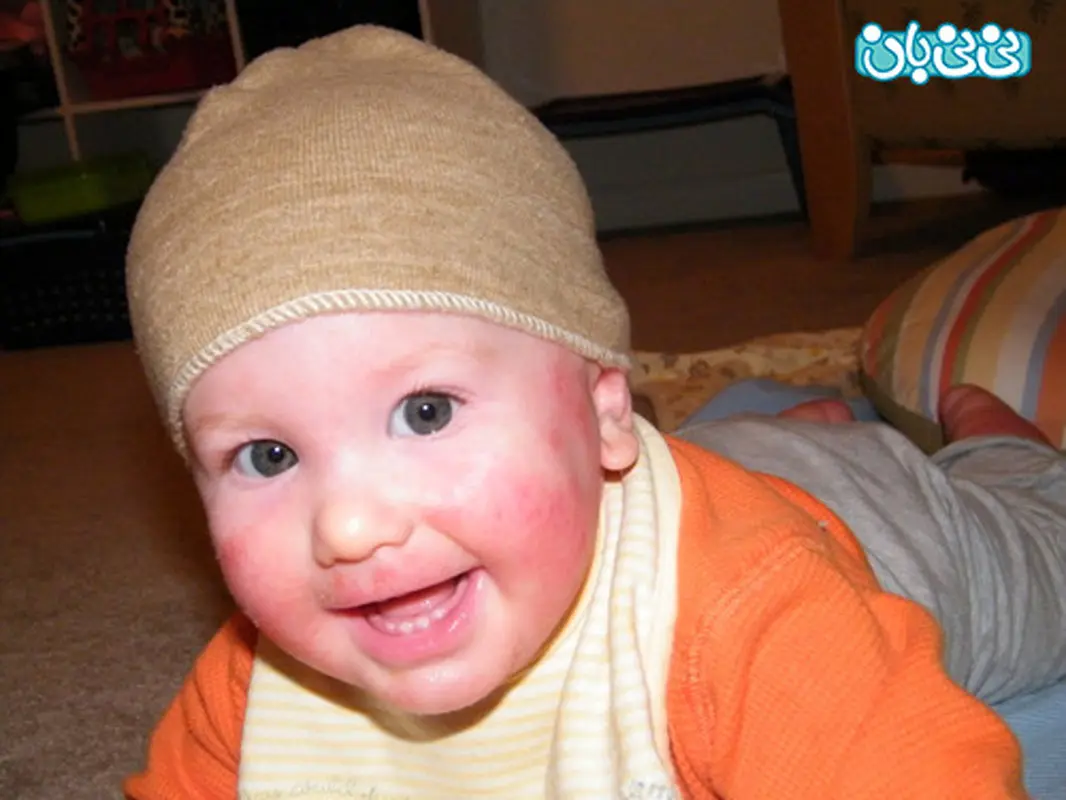 سوختگی پوست کودکان، درجه اول و دوم