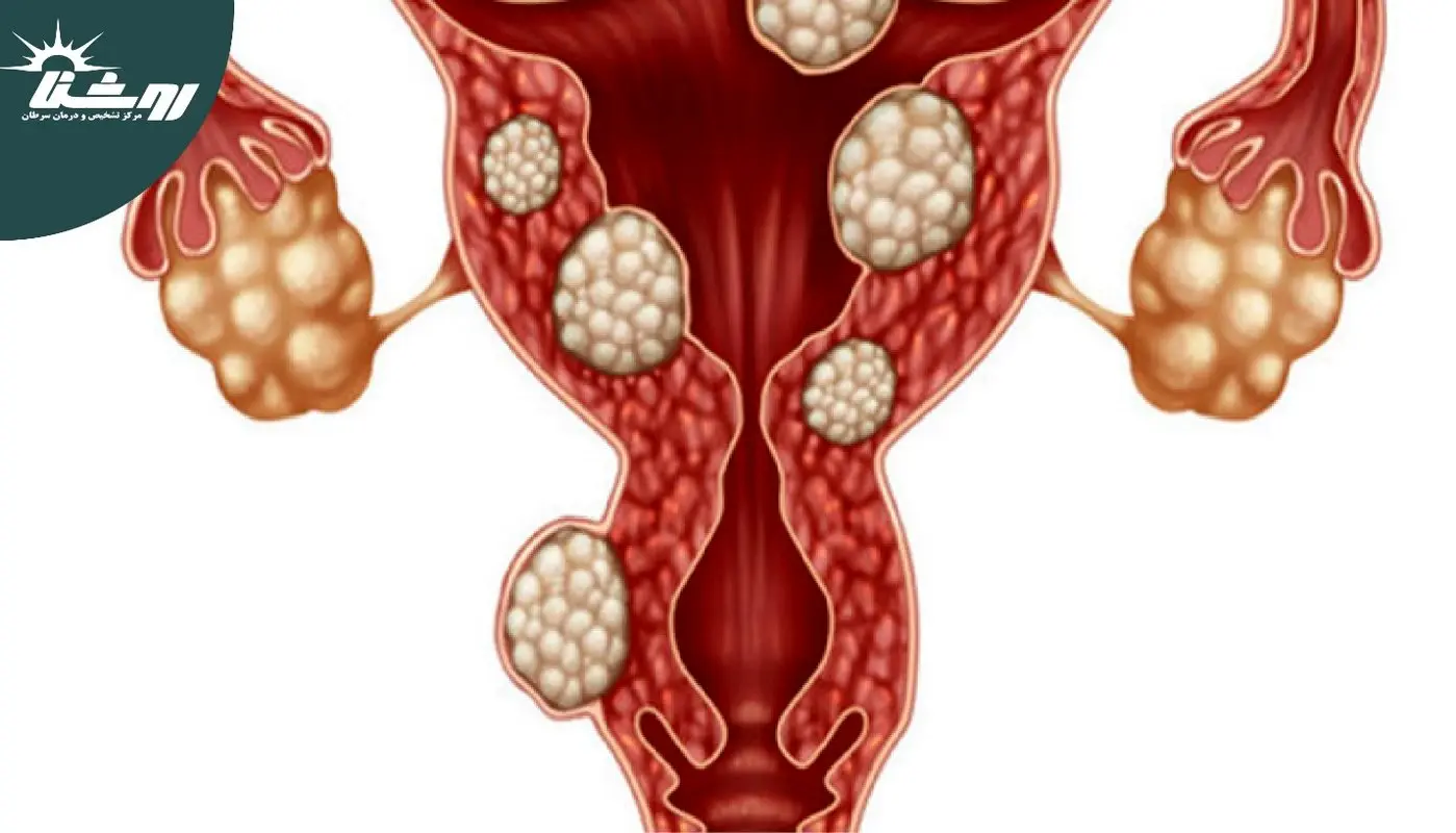 چه کسانی بیشتر در معرض فیبروم رحم هستند؟