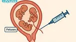 ریداکت جنین یا حذف جنین در بارداری‌های چند قلویی + 5 خطر آن