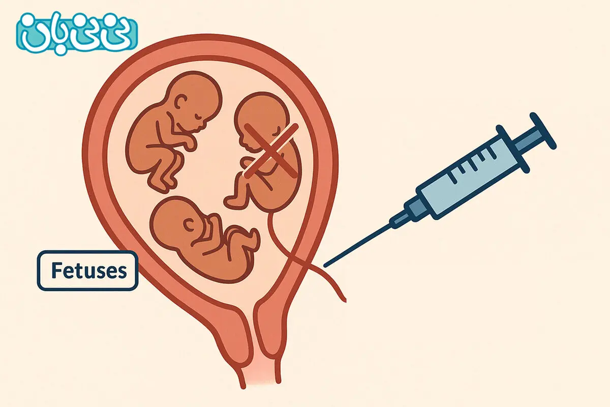 ریداکت جنین یا حذف جنین در بارداری‌های چند قلویی + 5 خطر آن