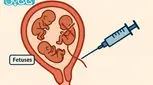ریداکت جنین یا حذف جنین در بارداری‌های چند قلویی + 5 خطر آن