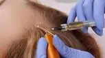 هیرفیلر چیست و چه کاربردی در تقویت و درمان مو دارد؟