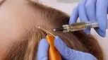 هیرفیلر چیست و چه کاربردی در تقویت و درمان مو دارد؟