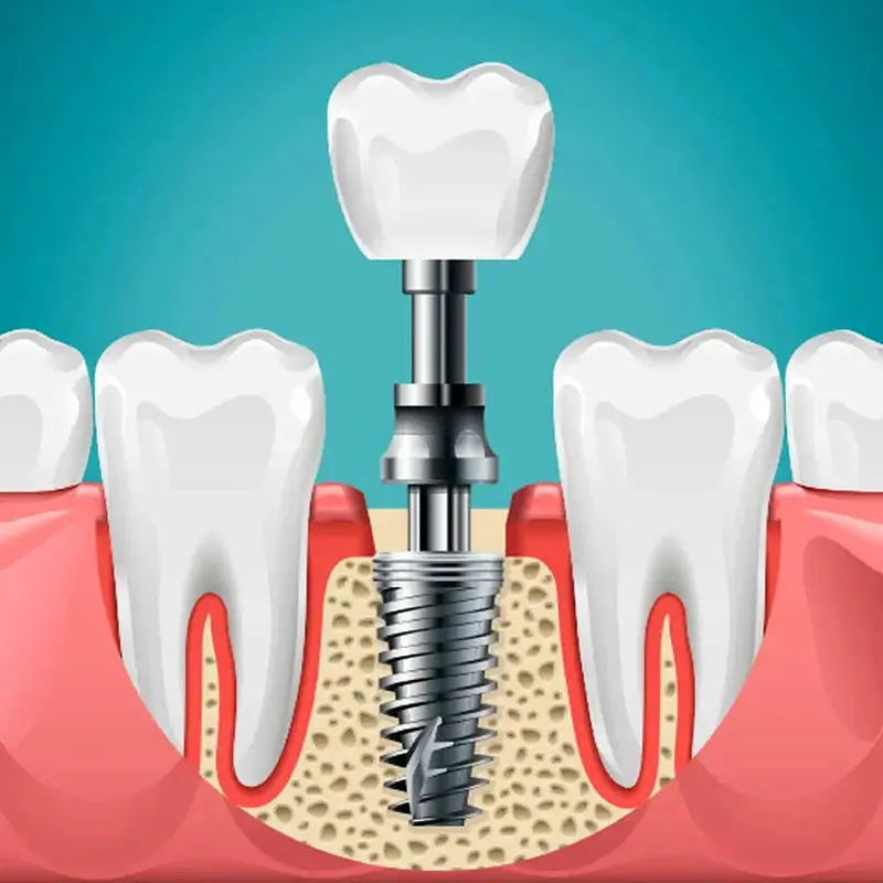 جایگزینی فضاهای بی دندان با ایمپلنت چگونه انجام میشود ؟