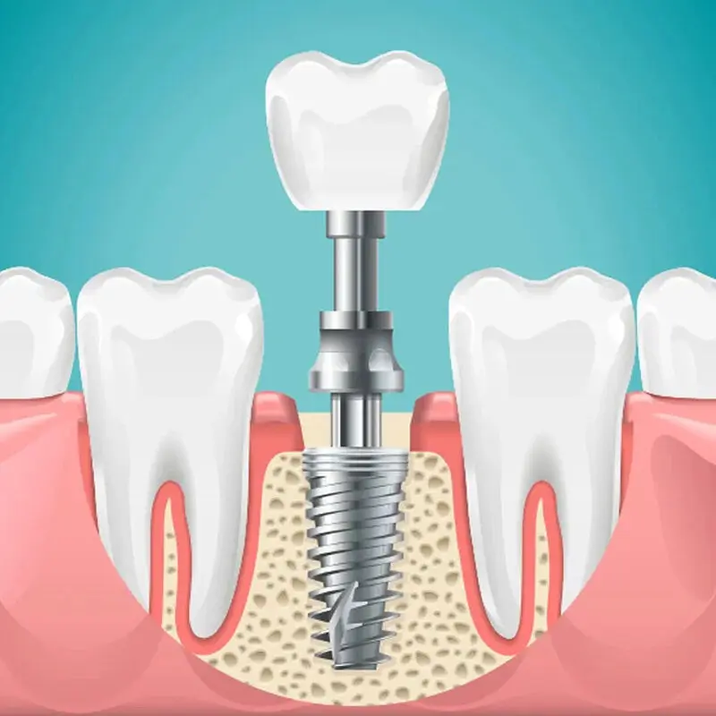 جایگزینی فضاهای بی دندان با ایمپلنت چگونه انجام میشود ؟