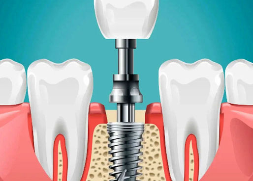 جایگزینی فضاهای بی دندان با ایمپلنت چگونه انجام میشود ؟