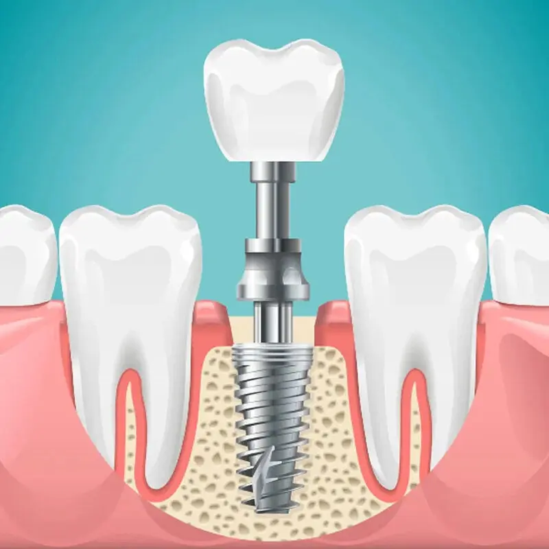 جایگزینی فضاهای بی دندان با ایمپلنت چگونه انجام میشود ؟