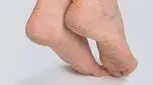 خداحافظی با خشکی و ترک پوست با این ویتامین‌ها