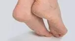 خداحافظی با خشکی و ترک پوست با این ویتامین‌ها