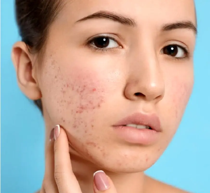 سابسیژن جای جوش چیست؟ مزایا و عوارض سابسیژن
