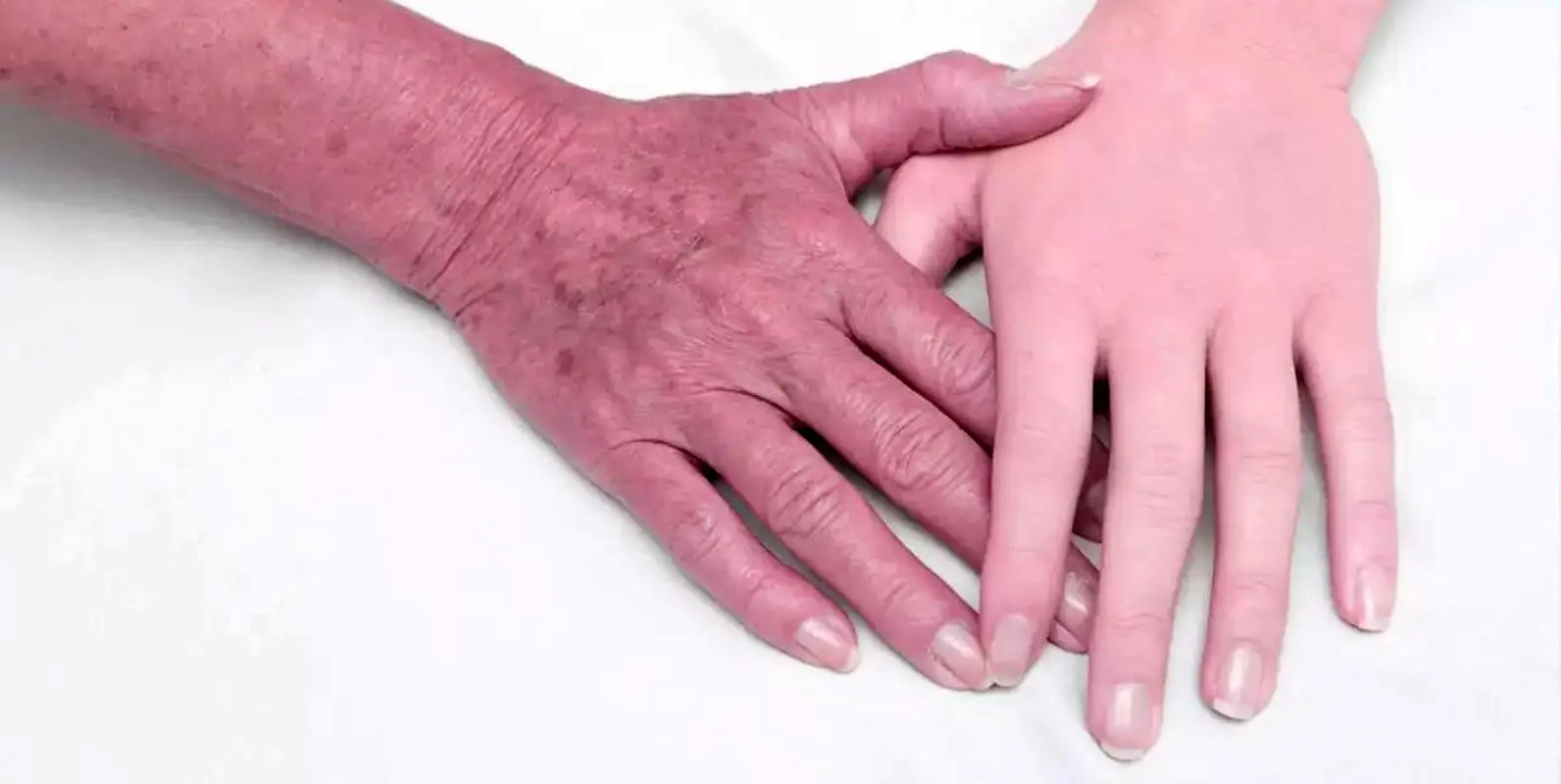 از پوست کرپی چه می‌دانید؟