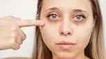 چرا زیر چشمم کبود و سیاه شده؟ راه حل‌های ساده و موثر
