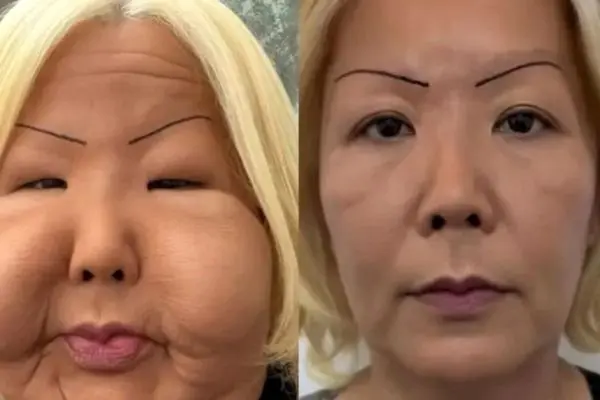 ببینید این اینفلوئنسر معروف برزیلی با عمل های زیبایی چه بلایی وحشتناکی سر صورتش آورد! (عکس)