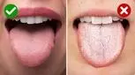همه چیز درباره سرطان زبان/ پیشگیری، علائم و درمان


