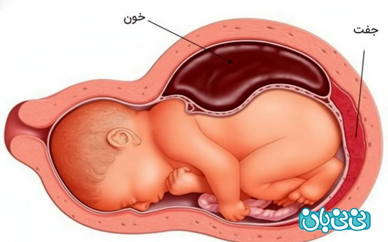 هماتوم در بارداری _ 7 دلیل ایجاد و علائم + روش‌های درمان