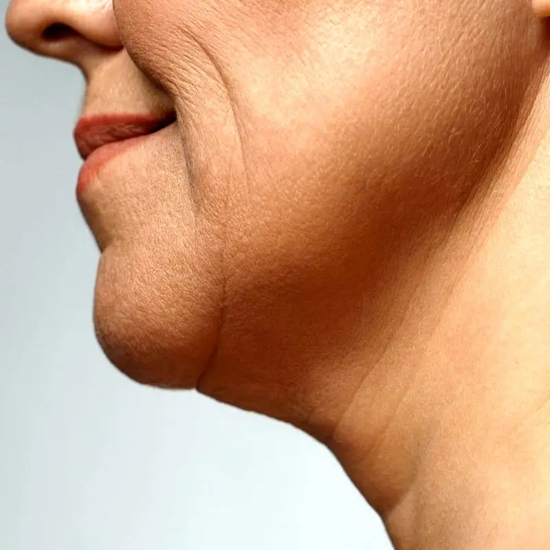 ماندگاری هایفوتراپی چقدر است و به چه عواملی بستگی دارد؟