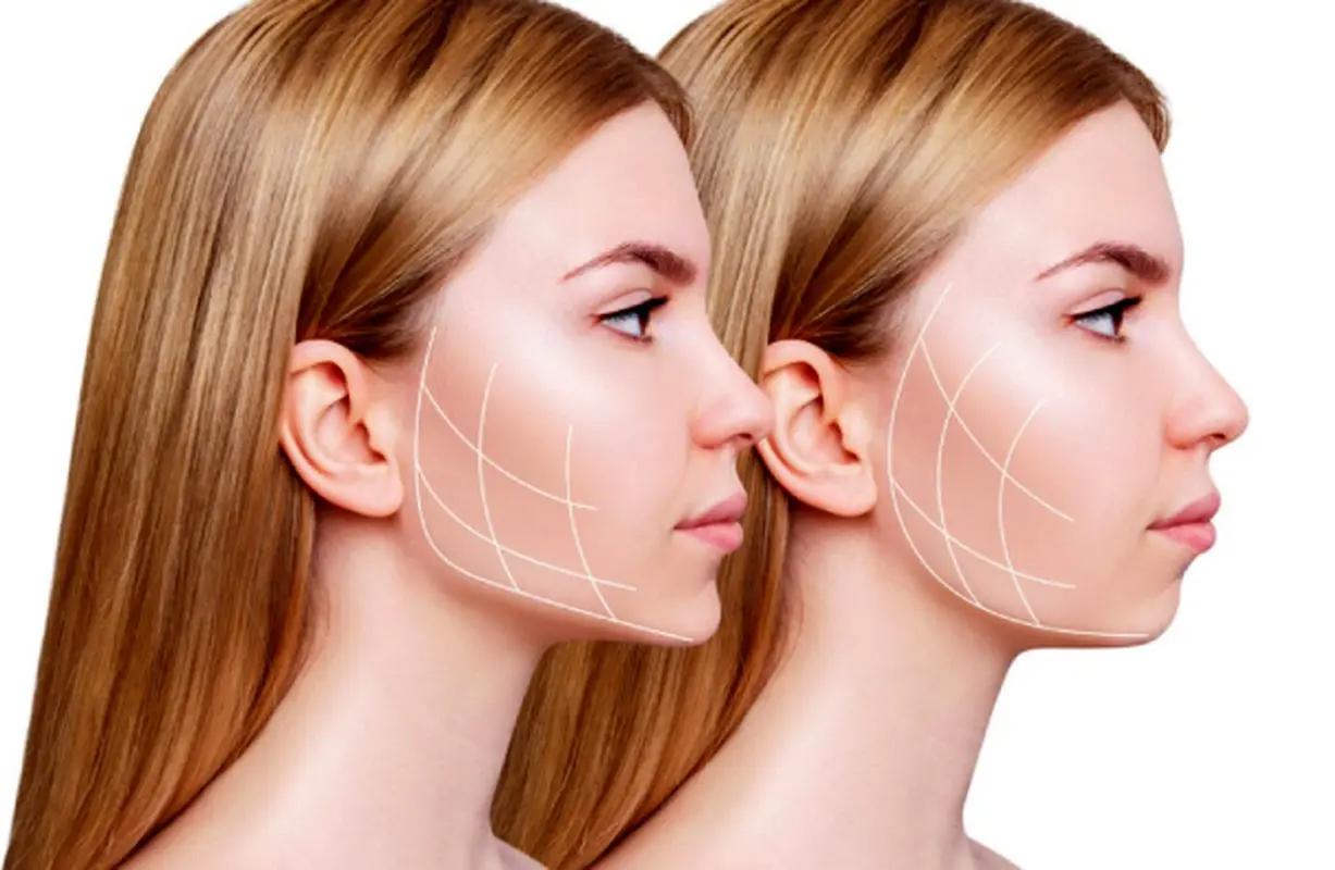 عمل بوکال فت یا همان تخلیه چربی دهانی را می شناسید؟