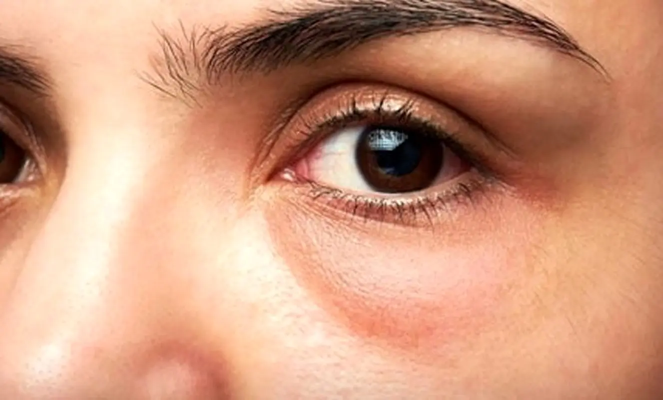 علل پف صبحگاهی چشمان چیست؟