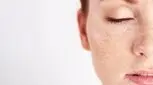 چرا بعد از ۳۰ سالگی لک‌های پوستی بیشتر می‌شوند؟