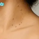 منگوله پوستی چیست و آیا واگیر دارد؟ روش‌های درمان پزشکی و خانگی