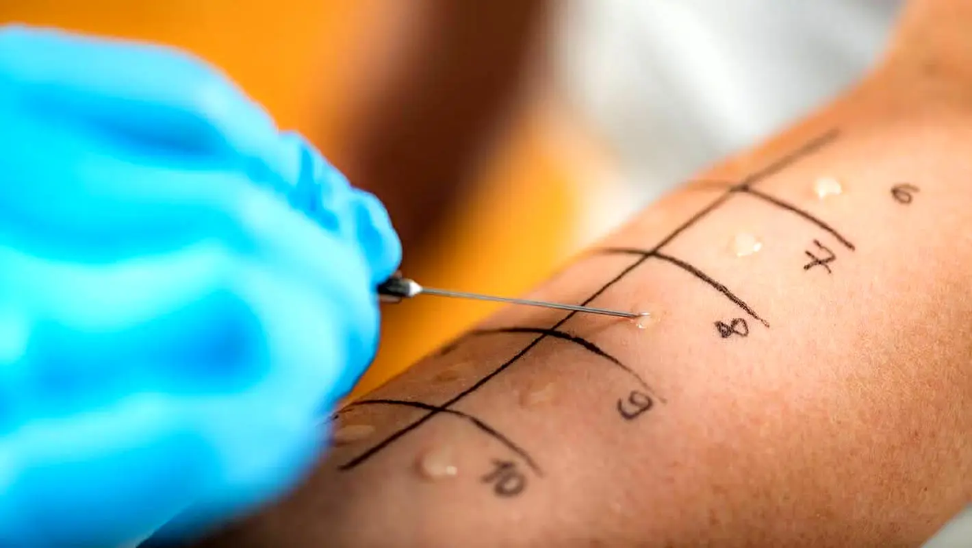 کاندید مناسب انجام تست آلرژی