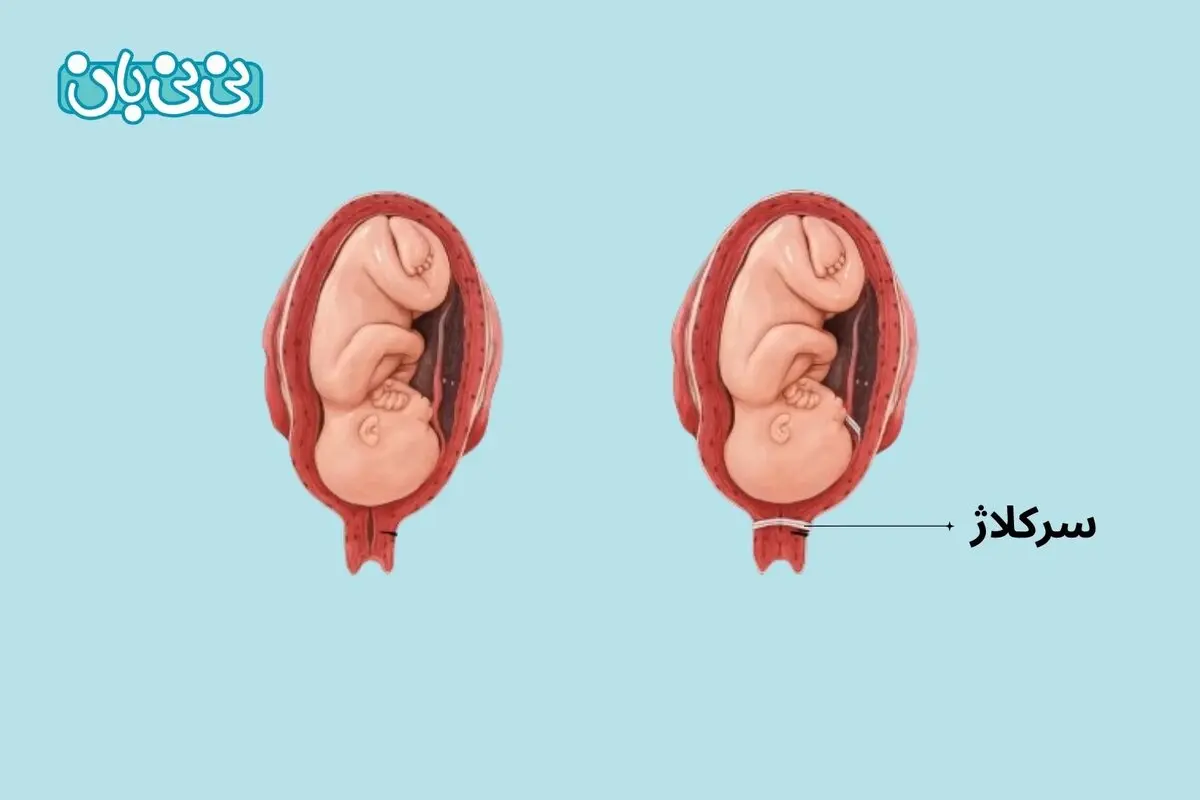 سرکلاژ در بارداری چیست؟6 مزایا و عوارض دوختن رحم + مراقبت ها