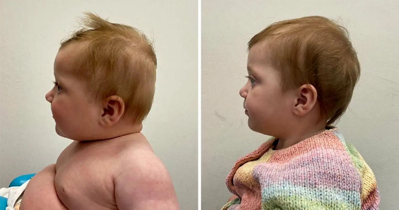 بیماری سندرم سر چیست؟/ تلفن همراه چه نقشی دارد؟