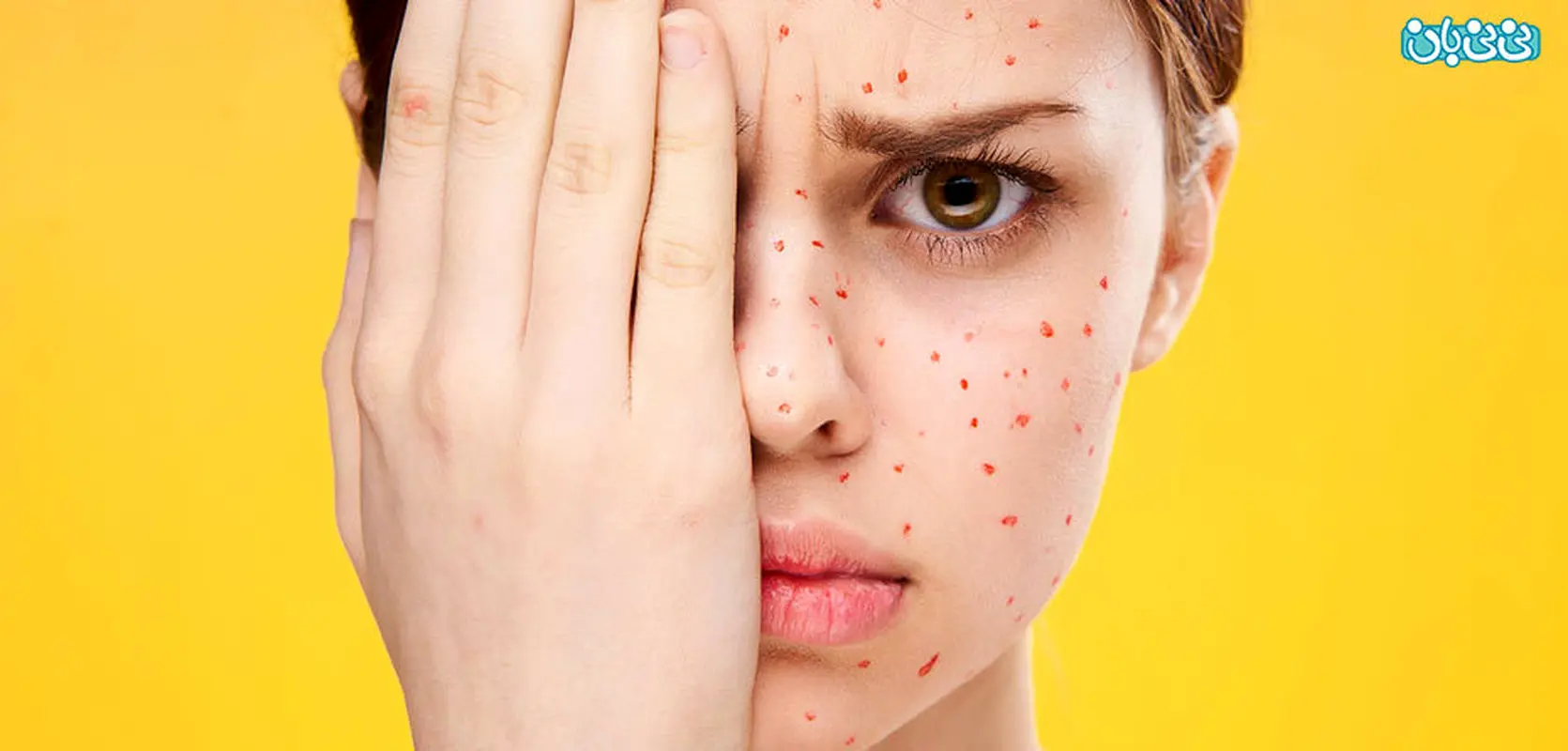 آبله مرغان در شیرخواران و حواشی آن