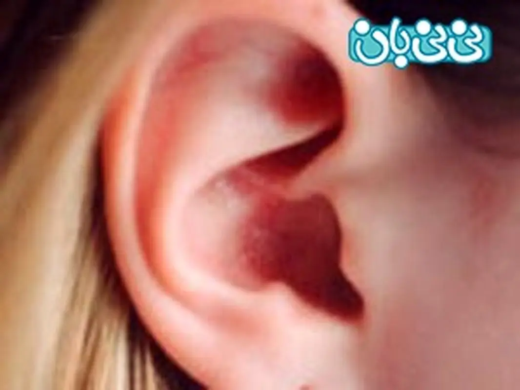 درمان اوریون با داروهای گیاهی