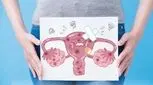 کاهش ذخیره تخمدان چه علائمی دارد؟