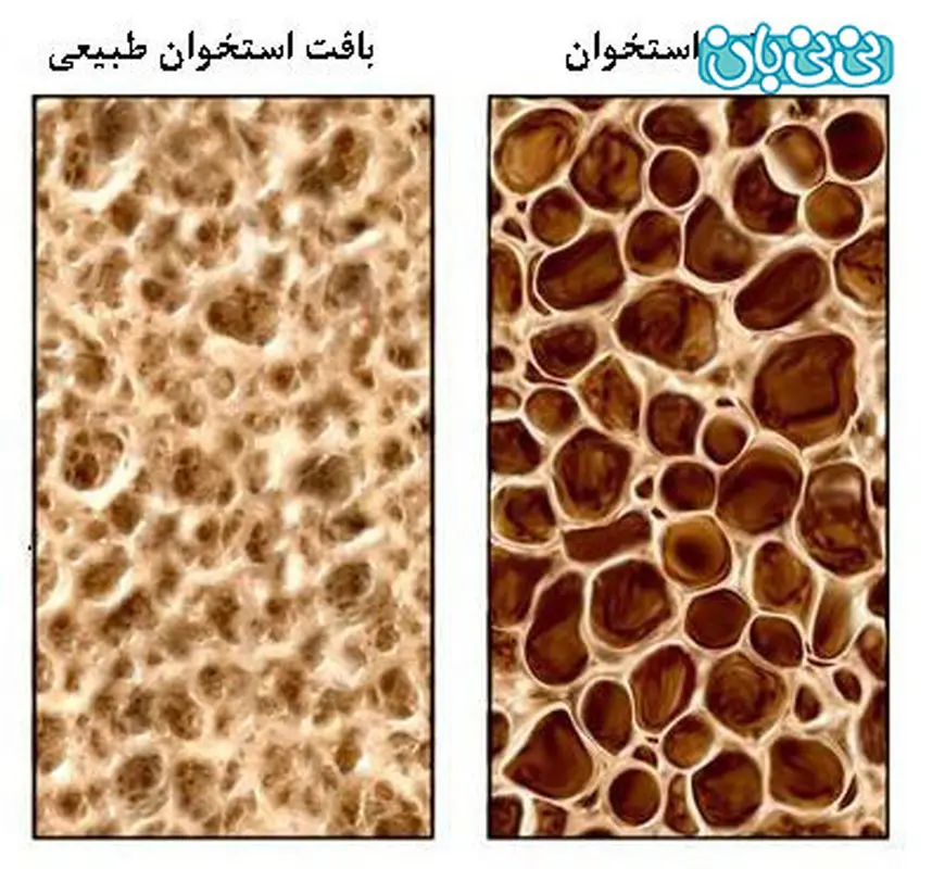 پوکی استخوان در زنان، بد نشستن مهم‌ترین عامل