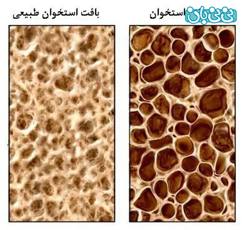 پوکی استخوان در زنان، بد نشستن مهم‌ترین عامل
