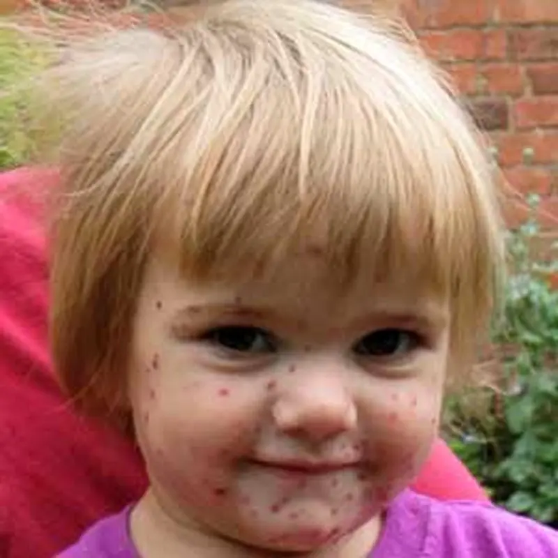 آبله مرغان در کودکان، علائم و درمان