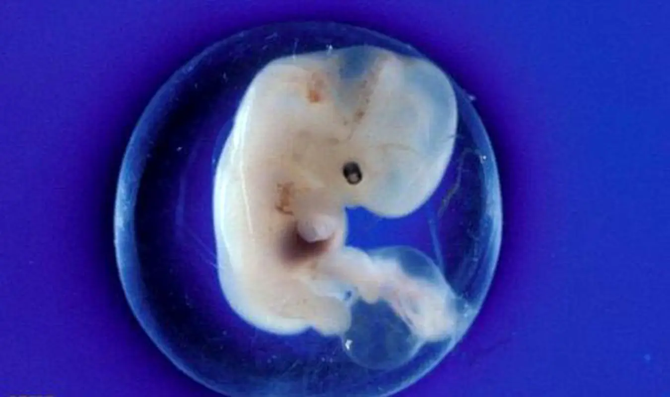 یک نوزاد درون کیسه آب، تولدی که نادر شد