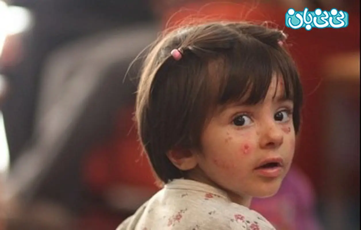 بیماری پروانه ای در کودکان، ارثی است؟