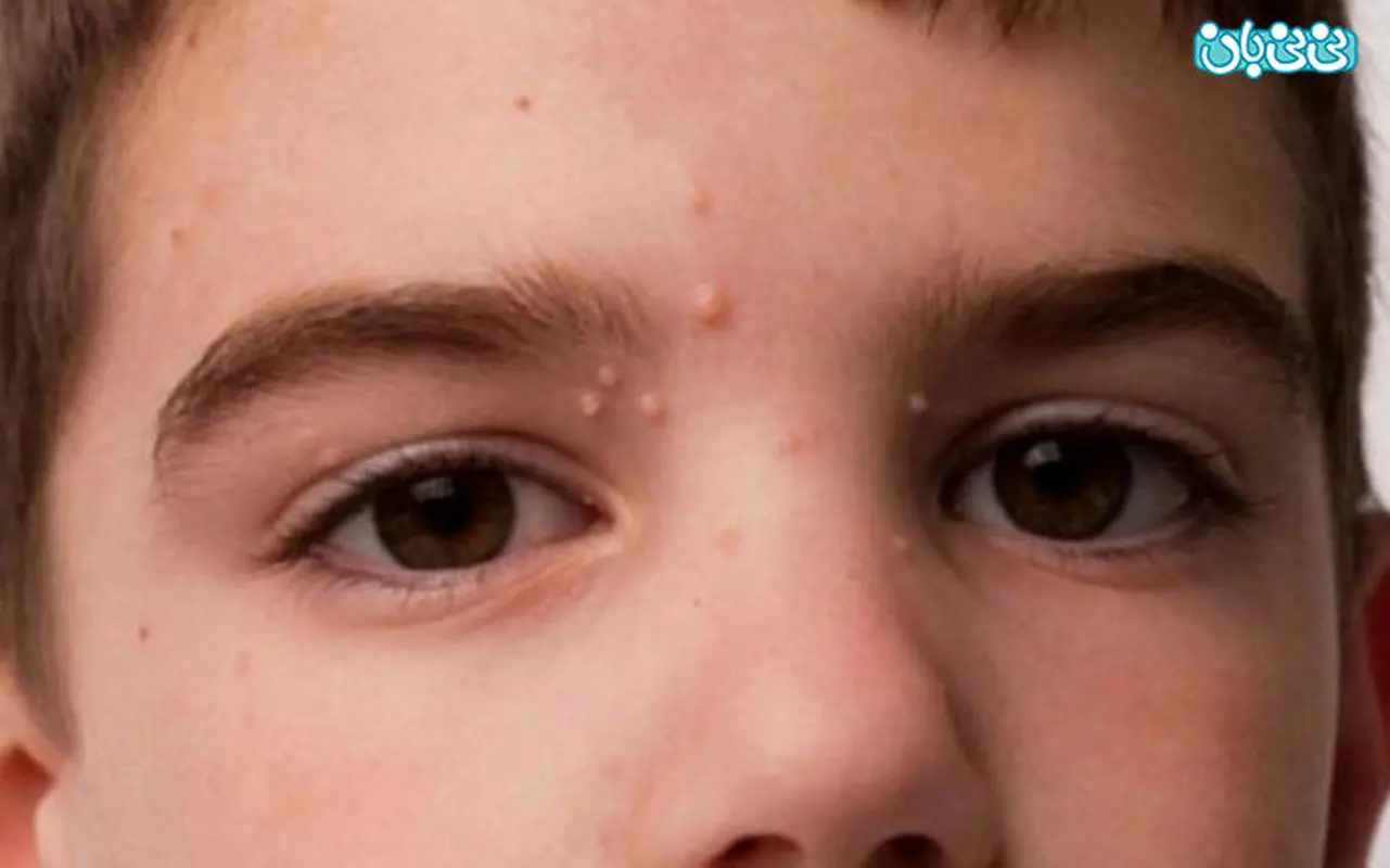 زگیل روی پوست بچه ها و روش های درمان آن