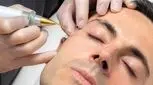 پلاسماتراپی پلک، غیر تهاجمی با بهبودی سریع