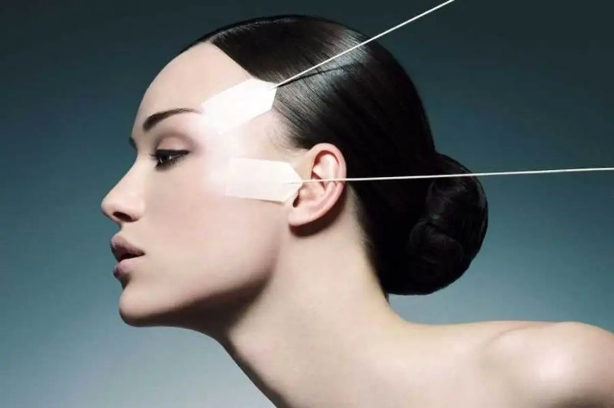 ماندگاری لیفت شقیقه با جراحی و نخ چقدر است؟