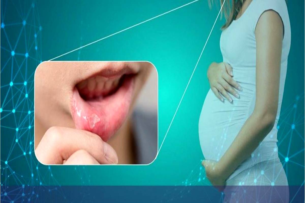 همه چیز درباره آفت دهان در دوران بارداری 