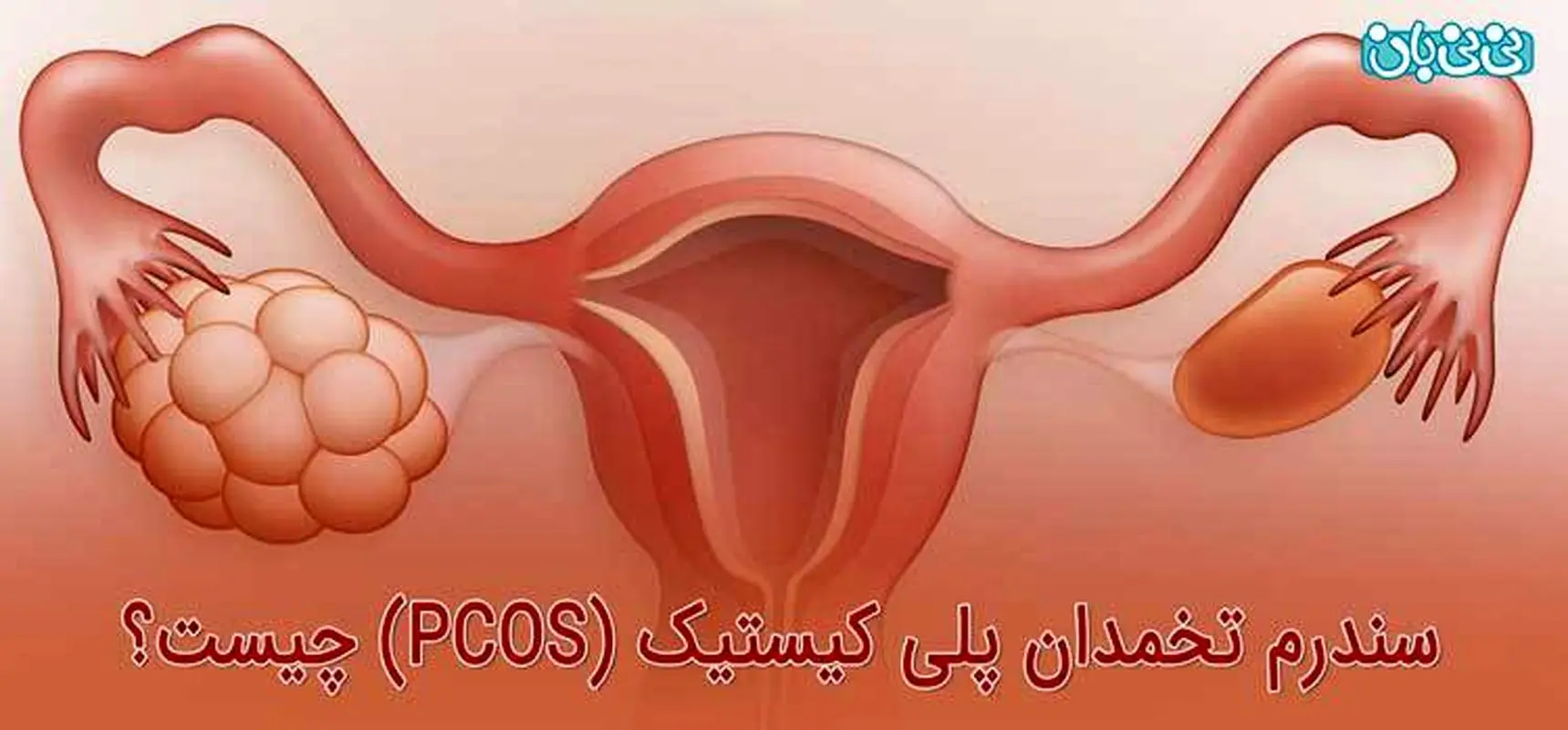 قاعدگی‌ نامنظم، باعث نازایی می شود؟