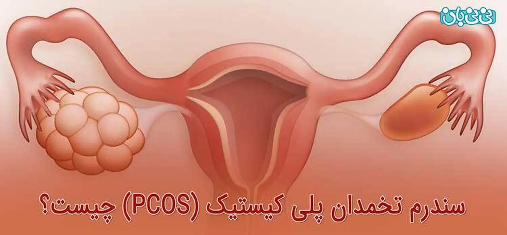 قاعدگی‌ نامنظم، باعث نازایی می شود؟