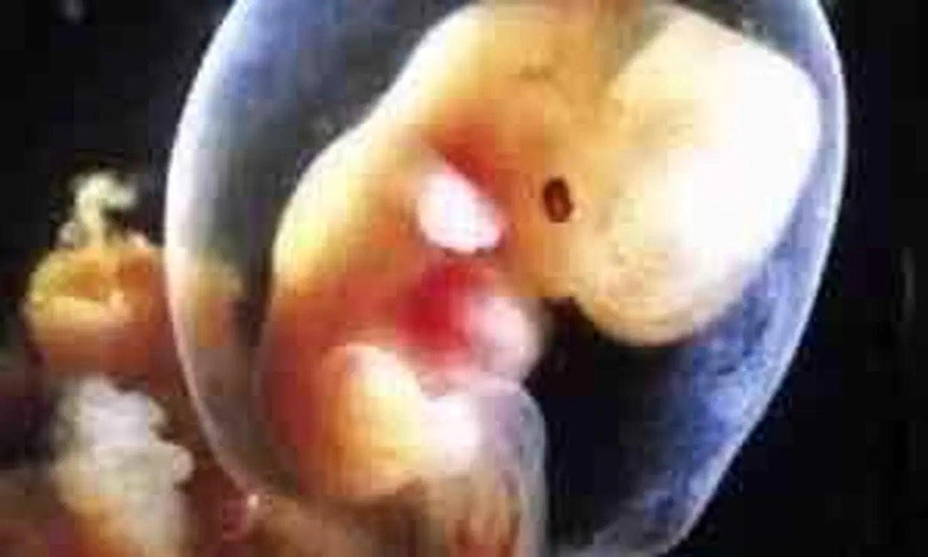 کمبود ید در دوران بارداری، عوارض