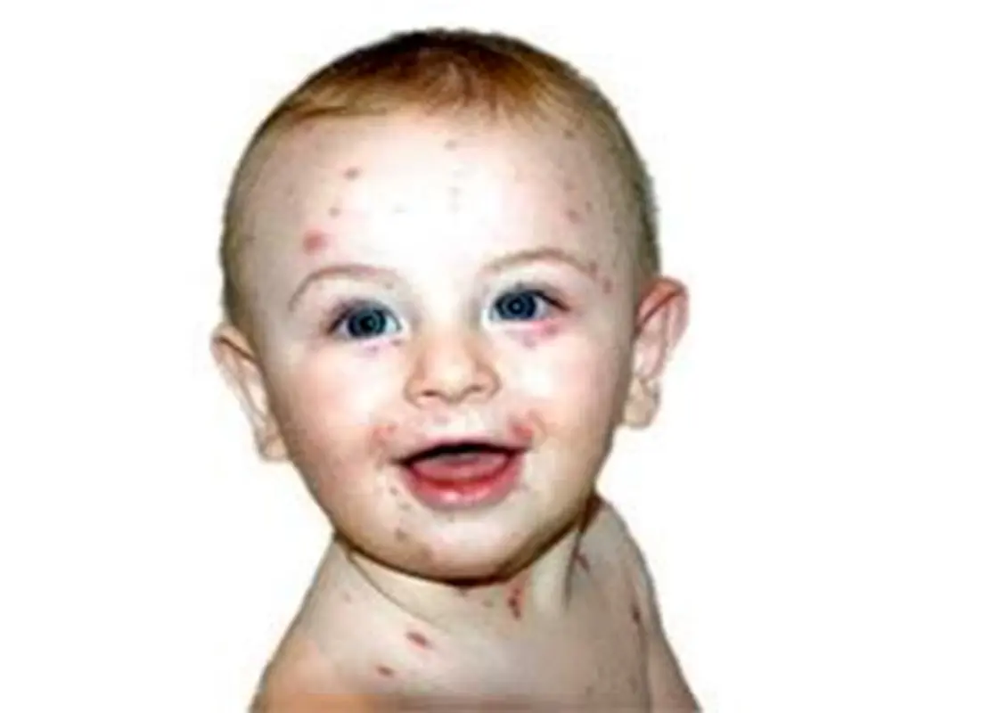 آبله مرغان در کودکان، مراقبت‌های خانگی