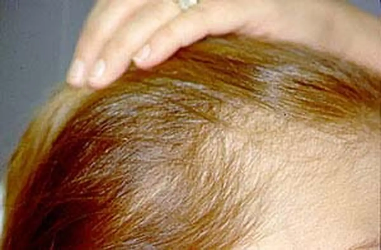 ریزش مو بعد زایمان، علتش چیست؟