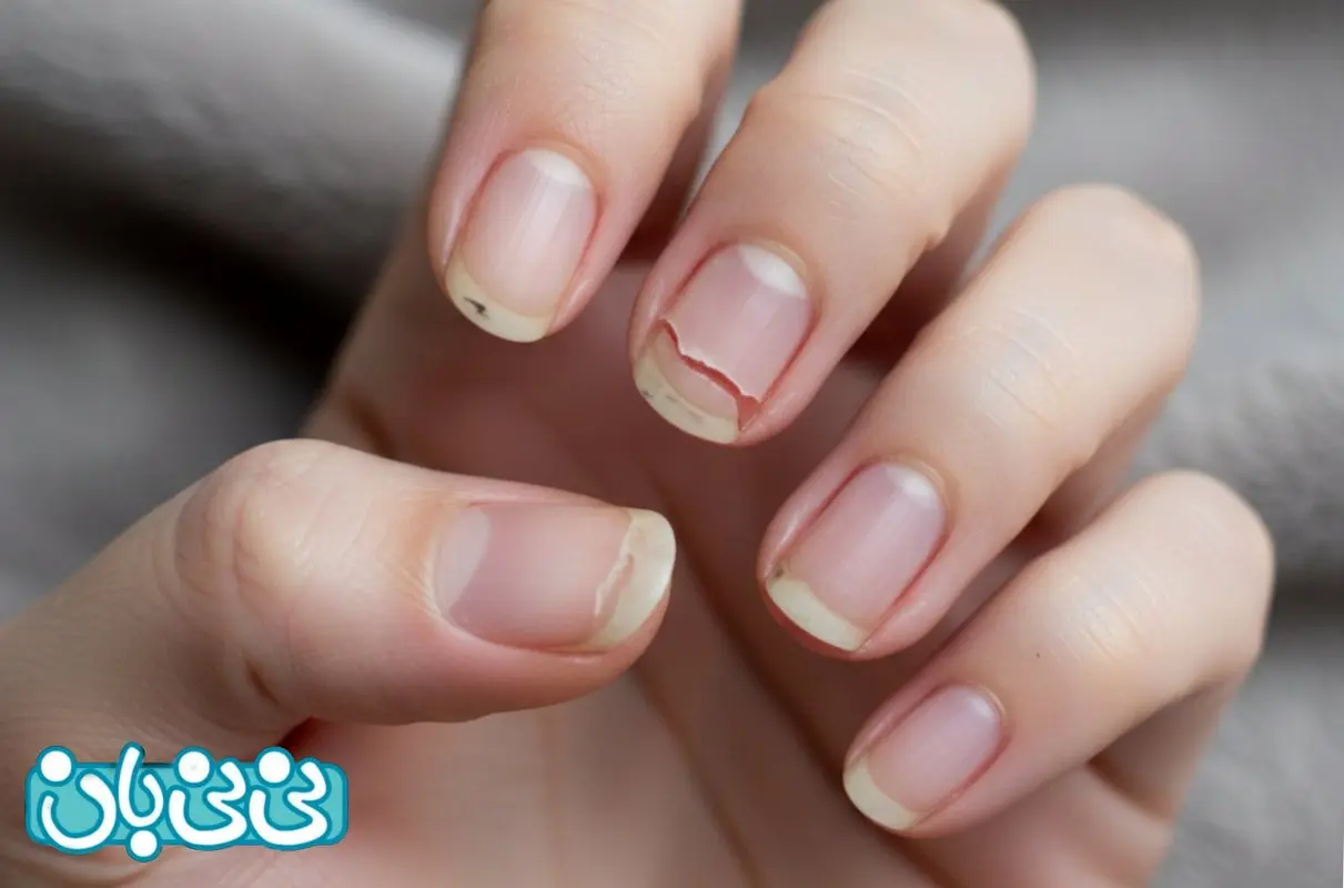 علت شکننده بودن ناخن‌ها و راه‌های درمان آن