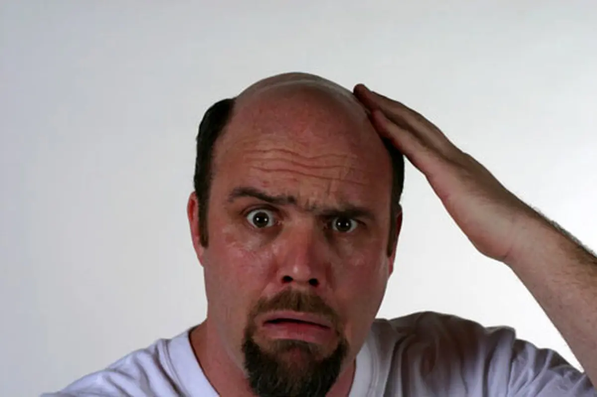 لک های دوران بارداری، مردان هم مبتلا میشوند؟