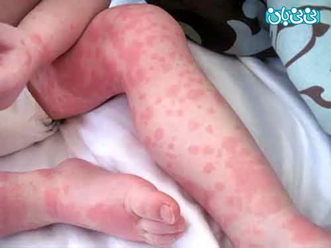 چرا بچه‌ها کهیر می زنند؟