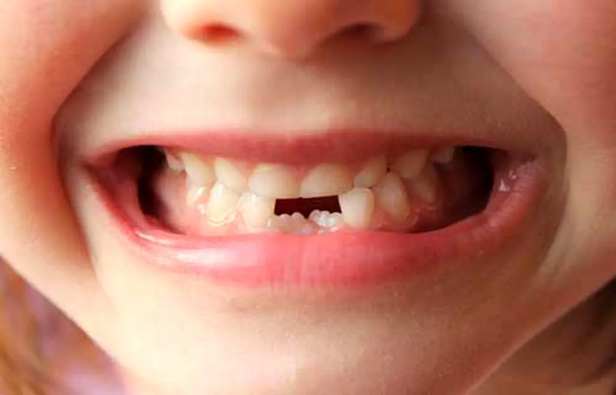 نقشه رشد دندان کودک را بشناسید